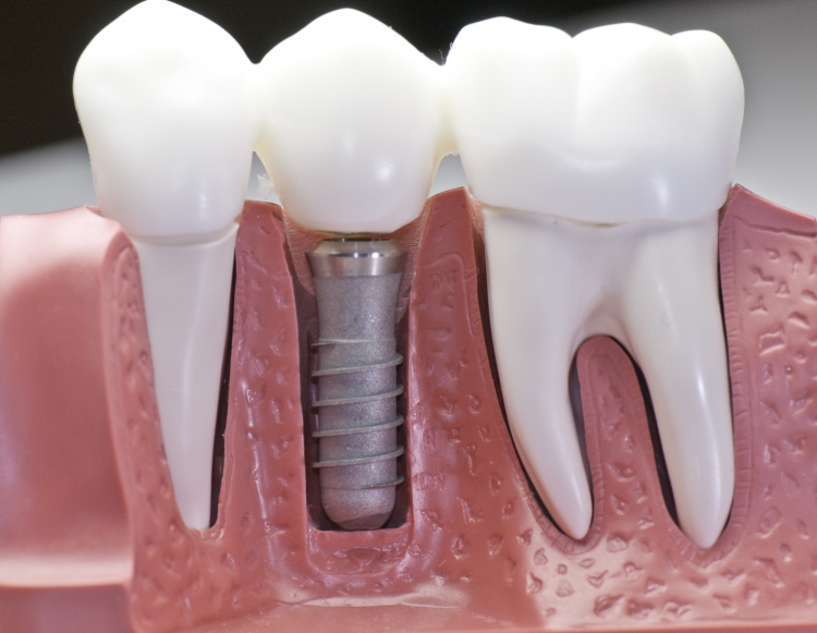 Implante Dentário