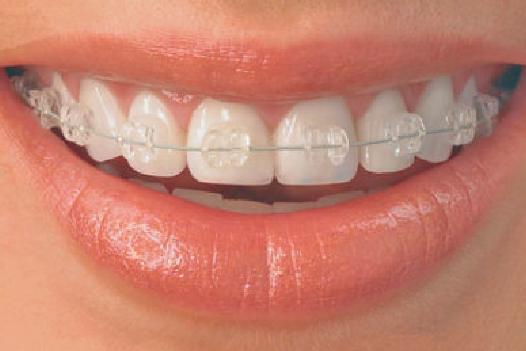 ortodontia invisalign