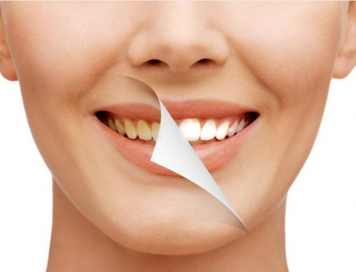 Tudo sobre Clareamento Dental