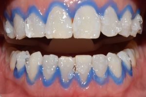 clareamento-dental-no-consultorio