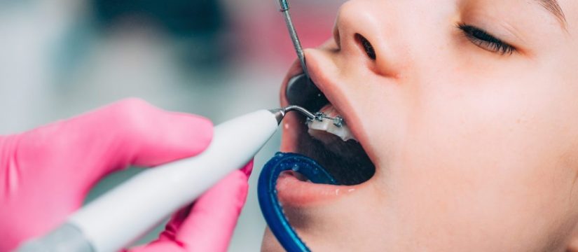 Limpeza dental com aparelho