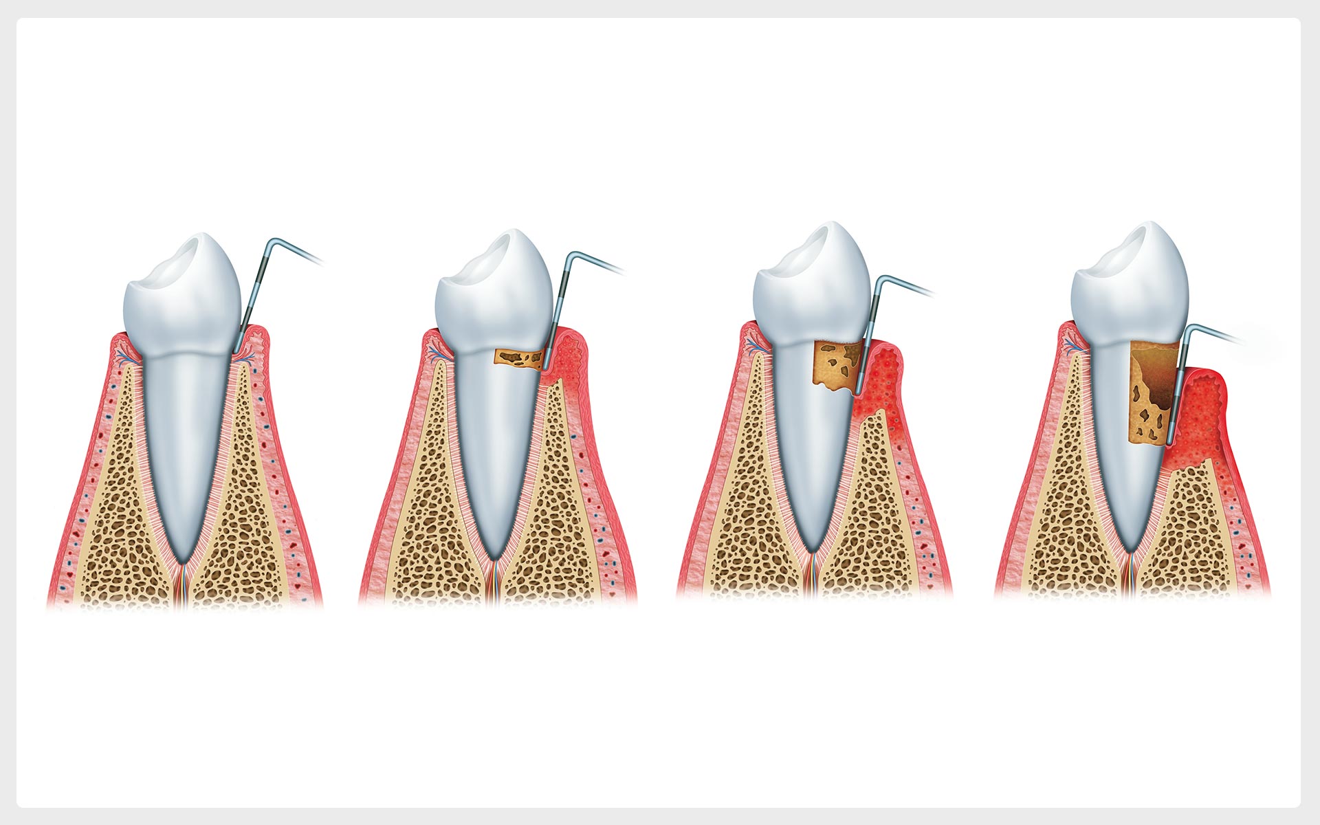 Limpeza dental