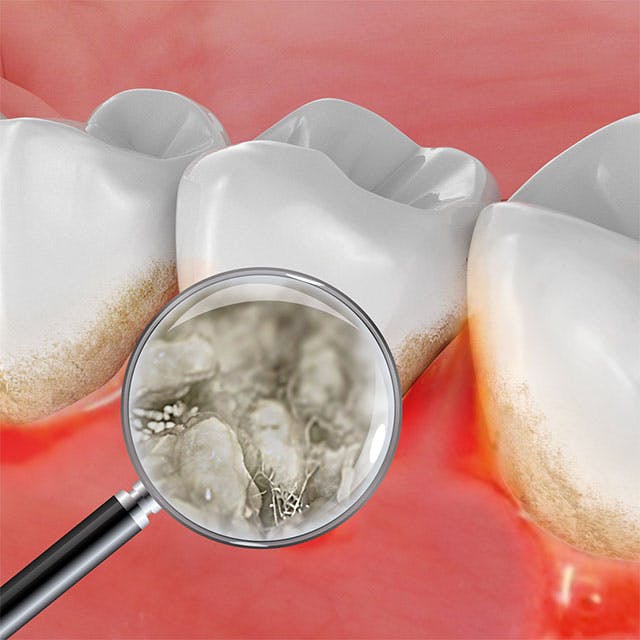 Tártaro dental