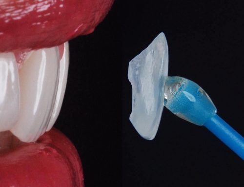 Tudo sobre Facetas e Lentes de contato dentais