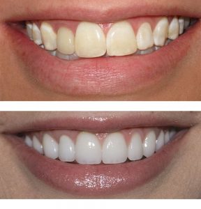 Faceta dental